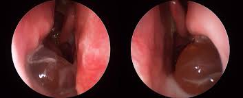 They often grow where the sinuses open into the nasal cavity. Modern Treatment For Nasal Polyps And Sinusitis
