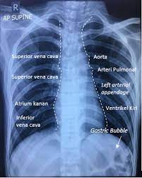 Rontgen thorax (rontgen dada) adalah salah satu metode pencitraan untuk melihat kondisi dan masalah di area dada, seperti jantung, paru, dan tulang rusuk. Interpretasi Rontgen Toraks Alomedika
