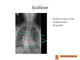 O'Donnell-Luria-Rodan syndroom