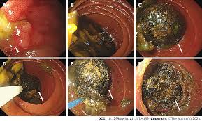 Recommended Colonoscopy Prep Diet – Richmond University Medical Center