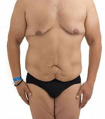 I had gastric bypass and my skin sags now. Gastric Bypass Plastic Surgery For Men In Nyc