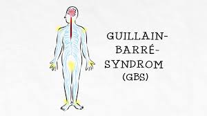 The diagnosis is usually established on the basis of symptoms and signs, aided by cerebrospinal fluid findings and electrophysiologic criteria. Informationsmaterial Gbs Initiative