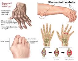 U functional limitation u extraarticular disease u rheumatoid factor positivity or presence of anticyclic. Rheumatoid Arthritis Rheumatoid Arthritis Treatment Healthclues