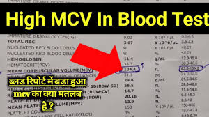 Mcv Blood Test In Hindi Mcv Test Mcv High In Blood Test Mcv Blood Test Results Youtube