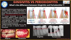 Meaning, pronunciation, synonyms, antonyms, origin, difficulty here you'll get most accurate definitions, close synonyms and antonyms, related words, phrases and. Periodontitis Gingivitis Meaning Symptoms Tx Gum Disease