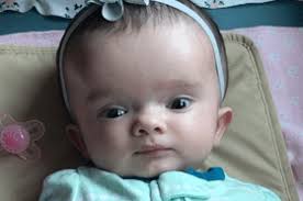 Image result for Hydrocephalus