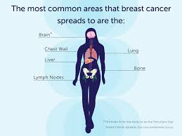 The specific signs and symptoms a person may have with metastatic breast cancer can vary significantly from one person to another. S Y M P T O M S O F M E T A S T A T I C B R E A S T C A N C E R Zonealarm Results