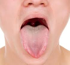 Image result for yellow tongue infection