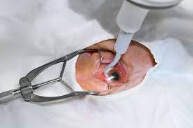 If not promptly treated, retinal. Retinal Detachment Surgery Treatment Cost Guide