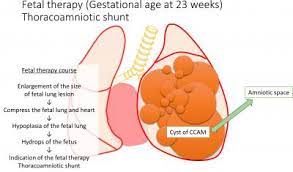 Découvrez le numéro de téléphone cpam ainsi que toutes les informations associées (horaires pour un numéro de téléphone cpam. Successful Treatment For A Severe Case Of Fetal Lung Disorder Cpam Eurekalert Science News