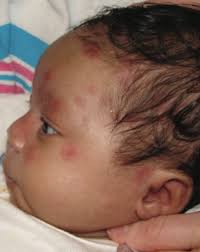 A Neonate With Skin Lesions: What's the Cause?
