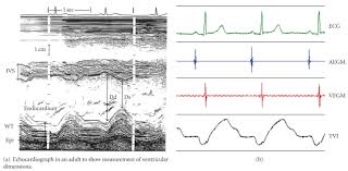 Try tvi free for 30 days. Trans Valvular Impedance Tvi System Medico Italy Tvi Waveform Download Scientific Diagram