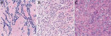 Mm has a wide range of histologic subtypes that are generally grouped under 1 of 3 major . Malignant Peritoneal Mesothelioma Prognostic Significance Of Clinical And Pathologic Parameters And Validation Of A Nuclear Grading System In A Multi Institutional Series Of 225 Cases Modern Pathology