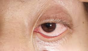 Image result for Eye Pain without Redness
