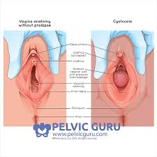 Image result for Urethral Prolapse
