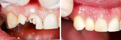If this isn't possible, you should be careful about what you eat. Tooth Filling Dental Fillings The Tooth Company
