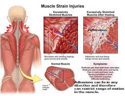 For more anatomy content please follow us and visit our website: Muscle Strains Back Pain From Shoveling Snow Balanced Body