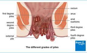 We did not find results for: Can Haemorrhoids Be Caused By Pregnancy The Rafaelo Procedure