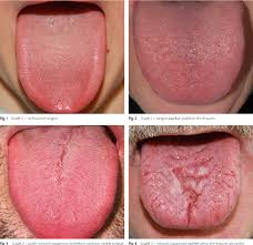 Image result for Fissured tongue