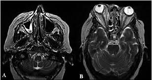 La trombosis del seno cavernoso se trata con antibióticos intravenosos en altas dosis, administrados a través de una vena (iv) si la causa es una infección. Trombosis De Seno Cavernoso Causada Por Zigomicosis Invasiva Fulminante A Proposito De Un Caso