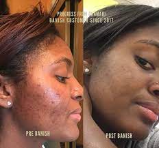 In general, there is no danger or risk associated with 1,000 milligrams of vitamin c daily in addition to your prescribed medications. Vitamin C Creme For Acne Scars Dark Marks Vitamin C Cream