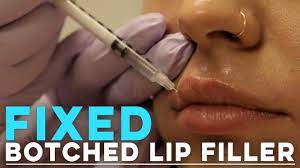 Lip filler before and after: Lip Injections Done Your Way Juvly Aesthetics