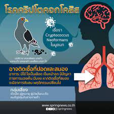 เชื้อรามูลนก เสี่ยงโรคคริปโตคอคโคสิส ทำปอดอักเสบ เชื้อรามูลนก ที่มาจากนกพิราบ เสี่ยงโรคคริปโตคอกโคสิส อันตรายร้ายเเรง ส่งผลให้มีอาการปอด. Springnews à¸£à¸°à¸§ à¸‡ à¸¡ à¸¥à¸™à¸à¸ž à¸£à¸²à¸š Facebook