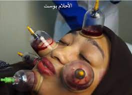 فوائد الحجامة المذهلة بالصور لأمراض الجسم وسهولة الانجاب وفك السحر الاحلام بوست