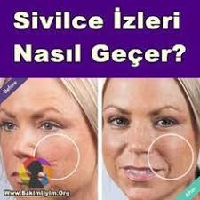 Yuzdeki Sivilce Lekeleri Nasil Gecer Dogal Maske Tarifleri Yuzdekisivilce Sivilce Sivilcenasilgecer Sivilcelekeler Sivilce Izi Cilt Urunleri Cilt Bakimi
