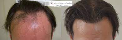 Prenota la tua visita gratuita da istituto helvetico sanders, centri tricologici leader per i trapianti con tecnica fue. Ultime Novita Sulla Calvizie E Sulla Tecnica Di Trapianto Capelli F U E Torino Oggi