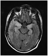 Image result for HSV Encephalitis