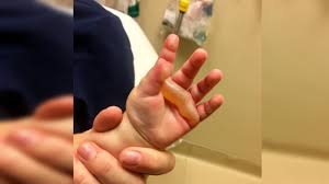 Austin Daycare Sued After Baby Severely Burns Both Hands Khou Com
