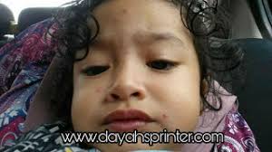 Chicken pox juga dikenali sebagai cacar air, jintungan atau bertih (mengikut dialek daerah). Musim Chicken Pox Dan Apa Perlu Buat Sekiranya Anak Kena Jangkitan Stokis Dyxy Putrajaya Cyberjaya Bangi