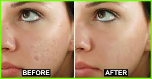 Concerned about your skin pigmentation or blotchy skin issues? What Is Hyperpigmentation The Skin Gets Its Color From A Pigment Called Melanin Skin Pigme Dark Patches On Skin Eliminate Wrinkles Hyperpigmentation Dark Skin