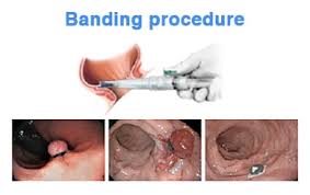They will be most painful when you have a bowel movement. Hemorrhoidal Disease Diagnosis And Management Mayo Clinic