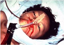 Image result for LASSA FEVER PICTURES