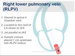 How To Identify Pulmonary Veins In Transthoracic Echocardiography Congenital Heart Disease Pulmonary Congenital Heart