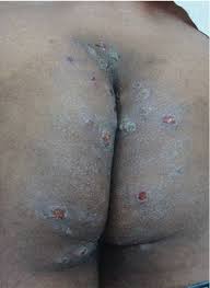 Image result for scabies in the groin area
