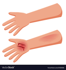 Set of injure hand Royalty Free Vector Image - VectorStock