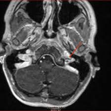 Magnetic resonance imaging of the brain