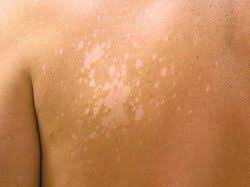 Profitez de millions d'applications android récentes, de jeux, de titres musicaux, de films, de séries, de livres, de magazines, et plus encore. Pigmentstorungen Helle Flecken Und Dunkle Knoten Pz Pharmazeutische Zeitung