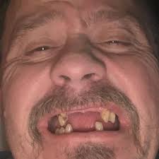 Fundraiser by Mike Bowman : Help Mike Restore His Smile and Confidence