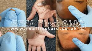 Image result for Capillary Refill