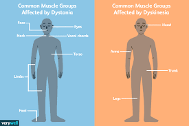 Dystonia Vs Dyskinesia In Parkinson S Disease