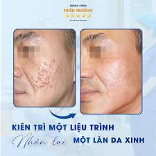 Top 6 Bác Sĩ Hô Trợ Điều Trị Sẹo Rỗ Hiệu Quả