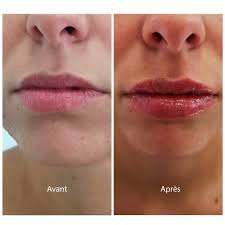 Buy hyaluron pen ampules 0.3 ml at vianacare.com online store and get low shipping rates on delivery from south korea. Hyaluron Pen Makeup Tattoo