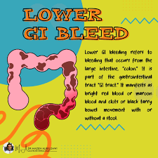 Image result for Small Intestinal Bleeding