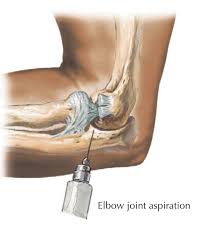 Image result for Elbow Joint Injection