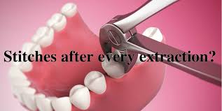 Pulling teeth due to damage or decay: Dental Questions Does Every Tooth Extraction Require Stitches