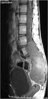 Myxopapillary Ependymoma Diagnostic Imaging Radiology Imaging Radiology